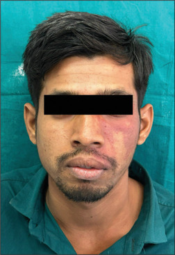Intraoral capillary hemangioma in Sturge-Weber syndrome - A rare case report and its periodontal management.