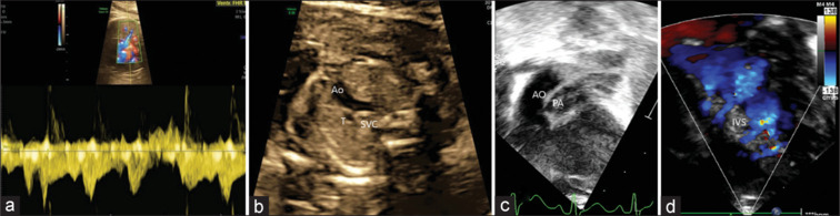 Forewarned is forearmed: The critical role of prenatal diagnosis in managing high-risk neonates with transposition of great arteries-intact ventricular septum.