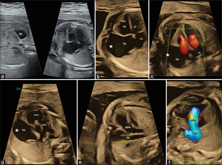Prenatally diagnosed congenital right atrial aneurysm using three/four-dimensional spatiotemporal image correlation fetal echocardiography.