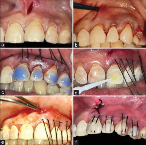 Comparative evaluation of vestibular incision subperiosteal tunnel access and coronally advanced flap in adjunction with platelet-rich fibrin for maxillary gingival recession - A randomized controlled study.