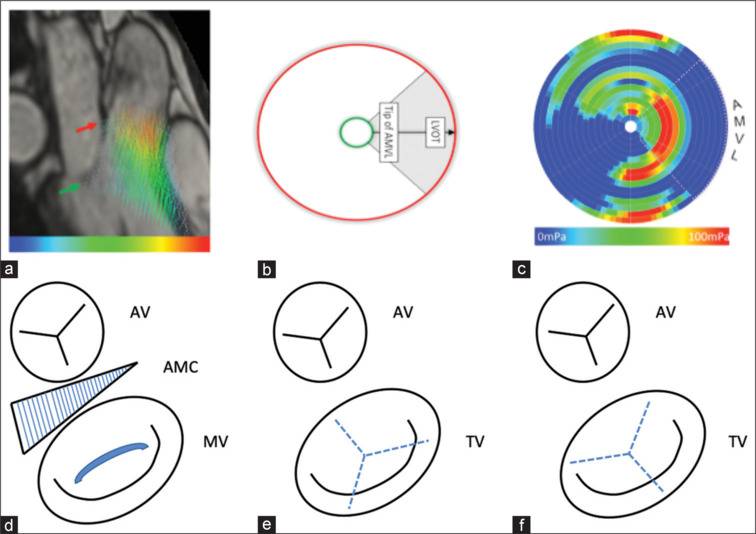 The systemic right ventricle: Is the tricuspid valve its "Achilles" heel'?