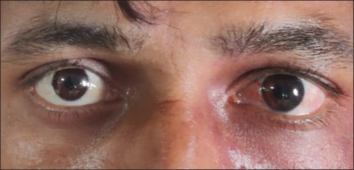 Intraoral capillary hemangioma in Sturge-Weber syndrome - A rare case report and its periodontal management.