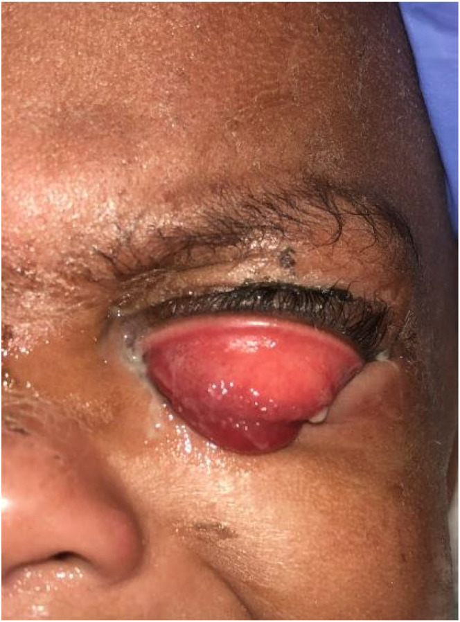 Gonococcal Conjunctivitis in Prepubertal Children.