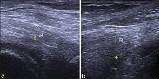 Ultrasonographic Evaluation of the Distal Medial Hamstring Tendons and their Association with Posteromedial Knee Pain.