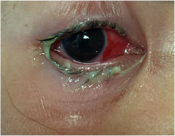 Gonococcal Conjunctivitis in Prepubertal Children.