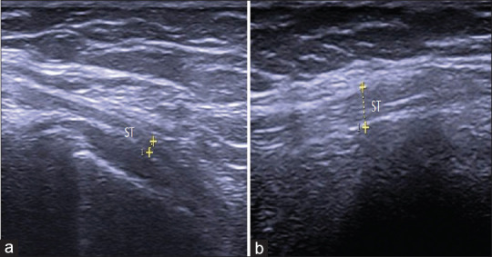 Ultrasonographic Evaluation of the Distal Medial Hamstring Tendons and their Association with Posteromedial Knee Pain.