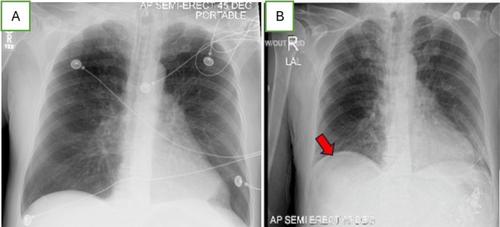 Gastric Perforation and Peritonitis Following Barium Swallow in a Patient With Prior Mechanical Ventilation and Stress Ulcer Prophylaxis: A Rare but Critical Complication