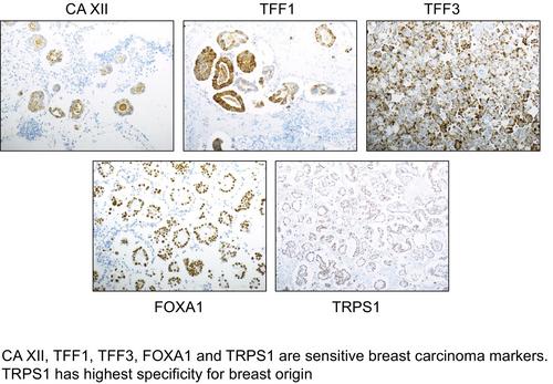 The Diagnostic Role of TFF1, TFF3, FOXA1, CA XII and TRPS1 in Serous Effusions