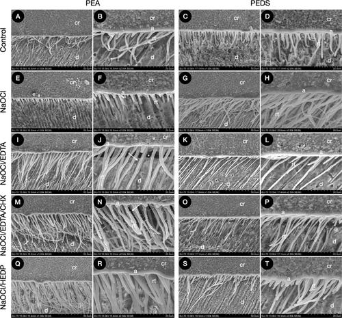 Advancing Adhesive Strategies for Endodontically Treated Teeth—Part II: Dentin Sealing Before Irrigation Increases Long-Term Microtensile Bond Strength to Coronal Dentin