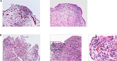 A Case of Interstitial Cystitis With Hunner Lesions Involving Bilateral Ureters