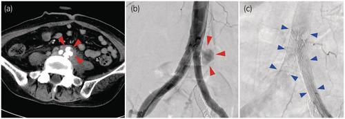 Ureteroarterial fistula: Late infectious common iliac artery pseudoaneurysm formation following successful endovascular stenting and literature review