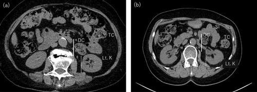 Mesh Fixation to the Sacral Promontory From the Left Side of the Mesosigmoid: Two Cases of Robot-Assisted Sacrocolpopexy for Persistent Descending Mesocolon