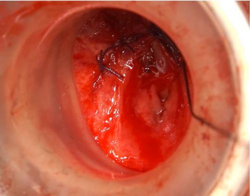 Successful Urethrorectal Fistula Repair Using GelPOINT Path Anal Access Sheath in Pelvic Fracture Urethral Injury