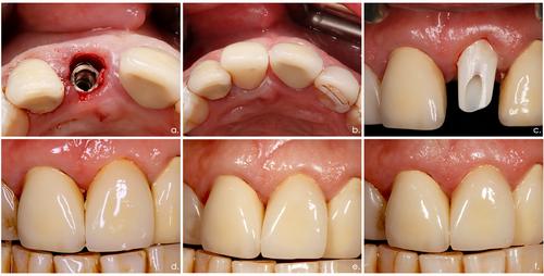 Clinical Performance of Immediately Placed and Restored Implants With a Novel Design in the Esthetic Zone. A 3-Year Follow-Up of Prospective Case Series