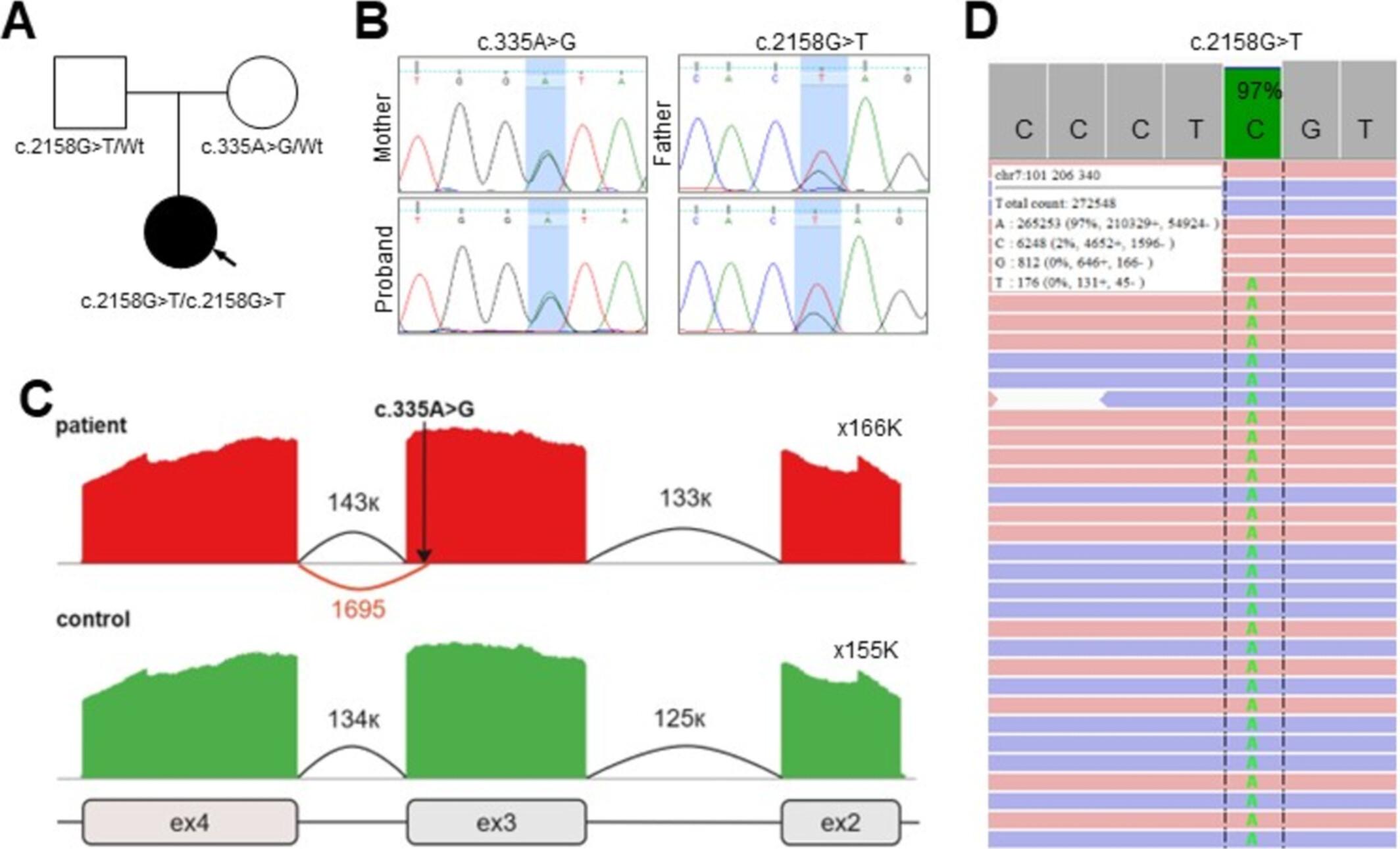 Expanding the Clinical Spectrum of BCARD Syndrome Caused by Novel Biallelic Variants in the PLOD3 Gene