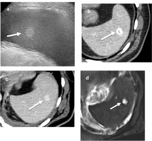 Splenic imaging and non-vascular intervention: when to intervene on the spleen and how to do it safely