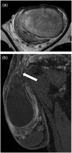 Transverse testicular ectopia with persistent müllerian duct syndrome: a case report