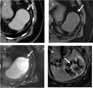 Splenic imaging and non-vascular intervention: when to intervene on the spleen and how to do it safely