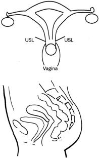 Endometriosis  MDC: role of the radiologist