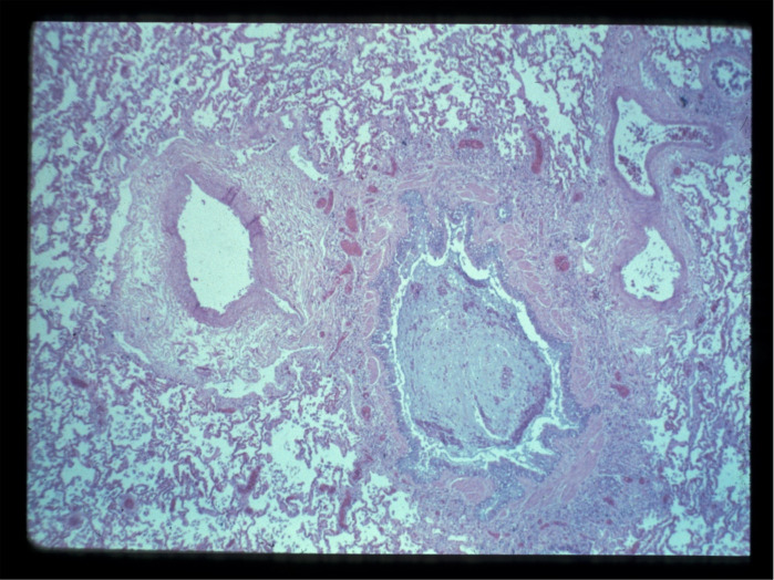 Does the airway circulation influence airflow obstruction in asthma?