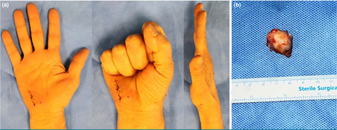 Guyon's canal syndrome caused by mass effect after chronic dog bite hand injury.