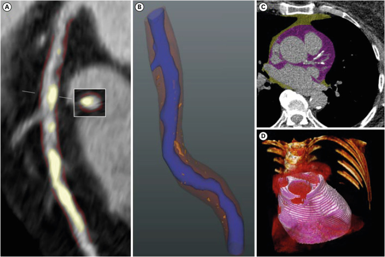 Non-calcified Coronary Plaque Burden is Related to Epicardial Adipose Tissue and Peri-coronary Adipose Tissue Attenuation in Heart Failure With Preserved Ejection Fraction.