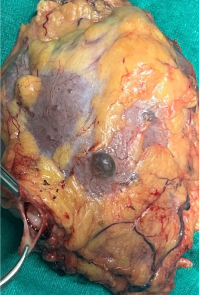A Decade of Surgical Management of Renal Cell Carcinoma with IVC Thrombus and Bilateral Renal Tumors: Emphasis on Auto-transplantation.