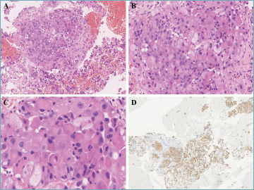 Eosinophilic vacuolated tumor of the kidney can have distant metastasis: a histo-molecular case study.