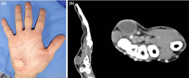 Guyon's canal syndrome caused by mass effect after chronic dog bite hand injury.