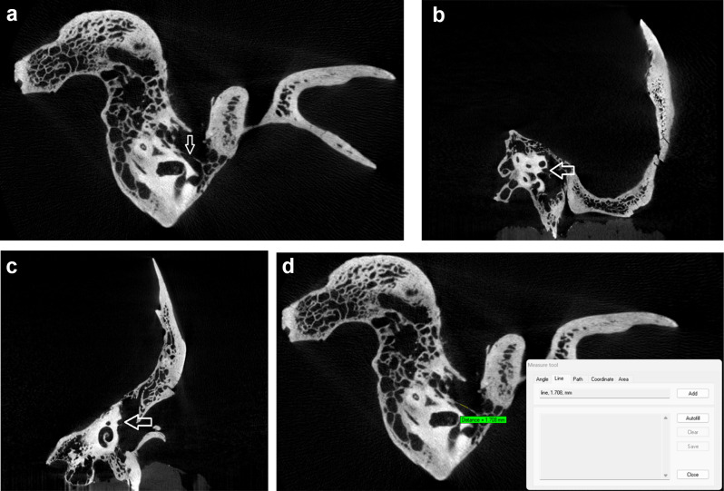Comparison of cone beam-computed and micro-computed tomography data for measuring facial canal dehiscence.