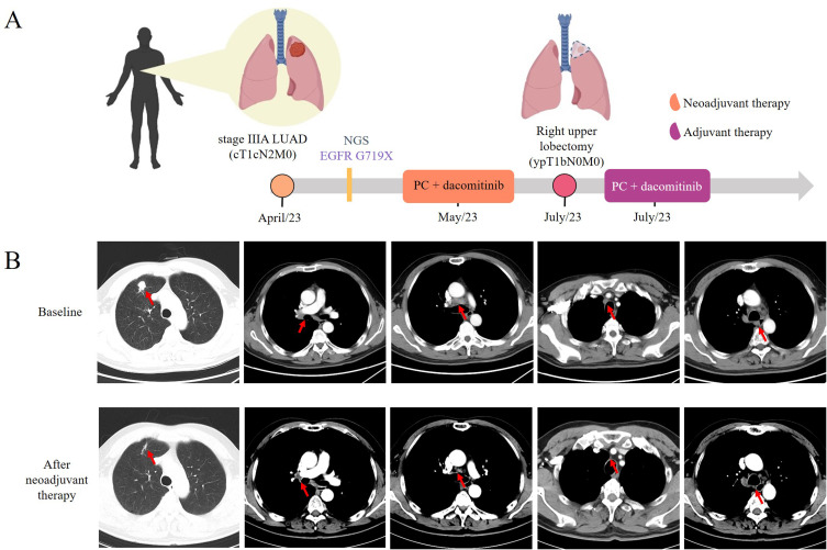 Neoadjuvant Targeted Therapy with Dacomitinib in a Stage IIIA Non-Small-Cell Lung Cancer Patient Harboring <i>EGFR</i> G719X: A Case Report.