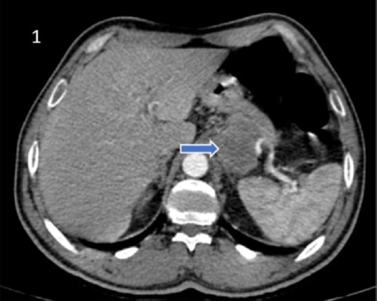 Case report and literature review of trophoblastic pancreatic carcinosarcoma presenting with gastric hemorrhage.