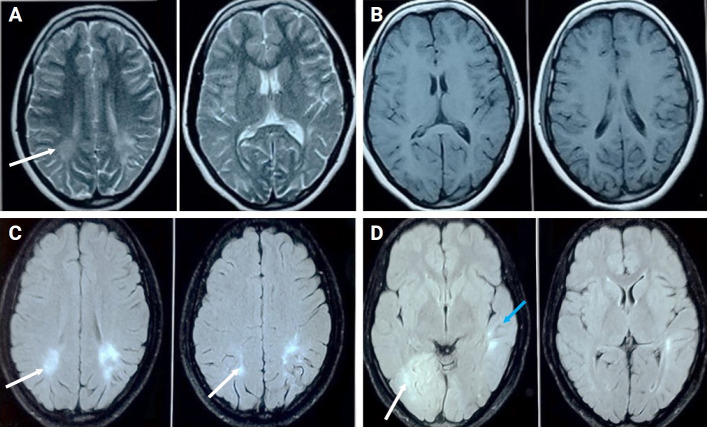 An interesting case of subacute sclerosing panencephalitis presenting with Balint's syndrome and dysautonomia.