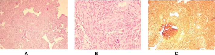 Diffuse alveolar hemorrhage as a clinical manifestation of cardiac angiosarcoma in a pregnant woman with antiphospholipid syndrome: case report and review of the literature.
