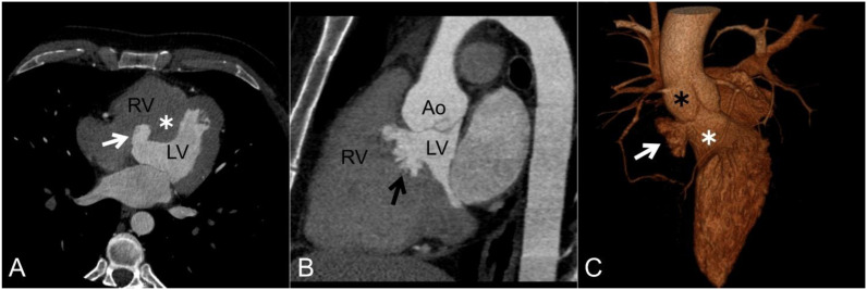 Interventricular Membranous Septal Aneurysm.