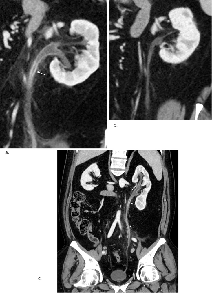 Cabazitaxel-induced ureteritis in metastatic castration-resistant prostate cancer patients: a single center case series 2014-2024.