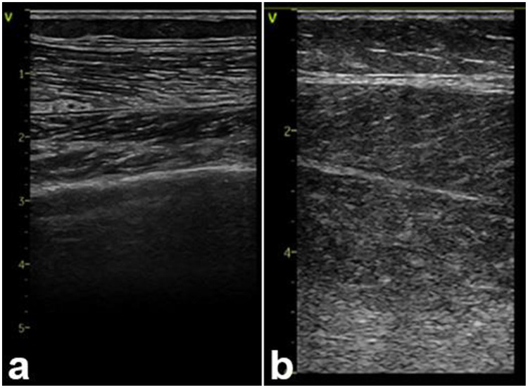 Fulminant Red Yeast Rice-Associated Rhabdomyolysis with Acute Liver Injury and Hyperkalemia Treated with Extracorporeal Blood Purification Using CytoSorb.