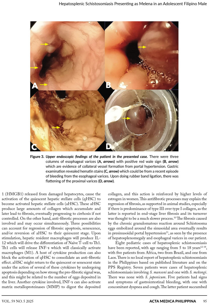 Hepatosplenic Schistosomiasis Presenting as Melena in an Adolescent Filipino Male: A Case Report and Literature Review.