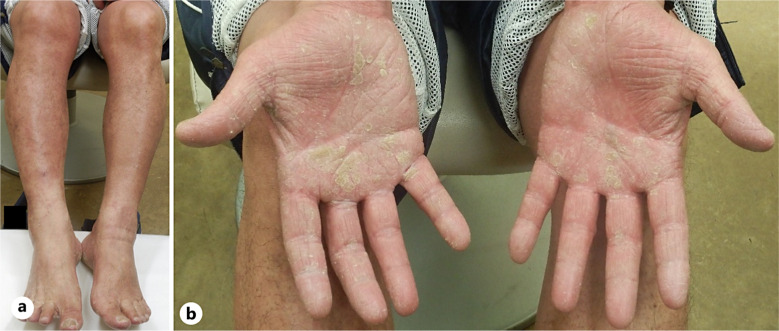 Trauma-Induced Psoriatic Arthritis: A Deep Köbner Phenomenon.