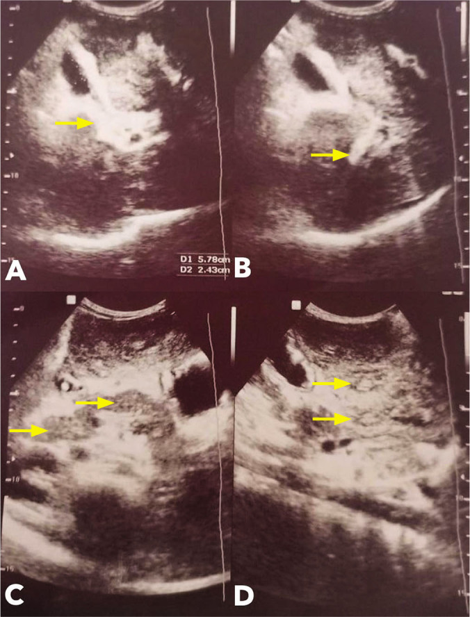 Hepatosplenic Schistosomiasis Presenting as Melena in an Adolescent Filipino Male: A Case Report and Literature Review.