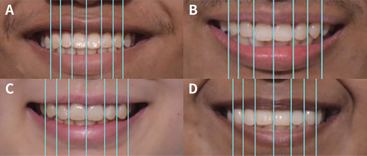 Self-perceived dental esthetics and the relationship to maxillary anterior tooth proportions among dental students.