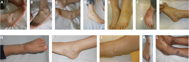 Bilateral Foot Skin Nodules in Children: Talar Callosities in 7 Patients and Differential Diagnosis.