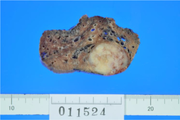 Pulmonary Carcinosarcoma Imitating Teratocarcinosarcoma: A Case Report.