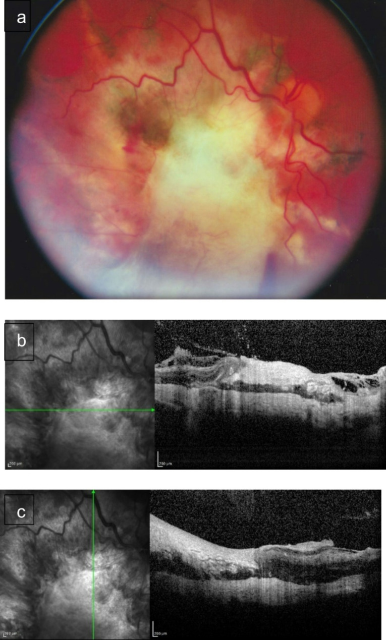 Outcomes of vitrectomy for chorioretinitis sclopetaria following blast-related ocular trauma.