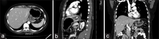 Computed tomography roadmap for post-operative fundoplication imaging with a novel structured reporting checklist.