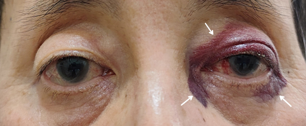 Raccoon Eye Caused by Dialysis-related Amyloidosis.