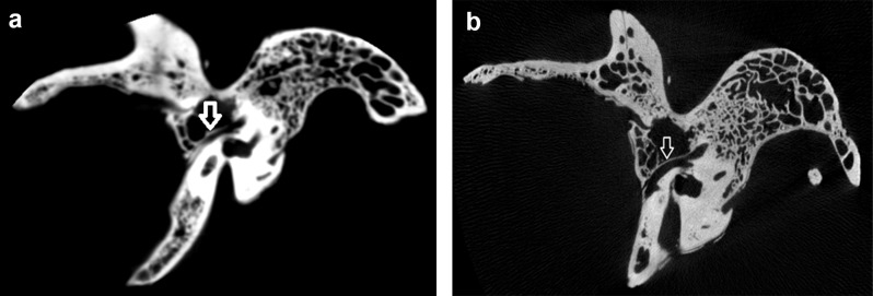Comparison of cone beam-computed and micro-computed tomography data for measuring facial canal dehiscence.