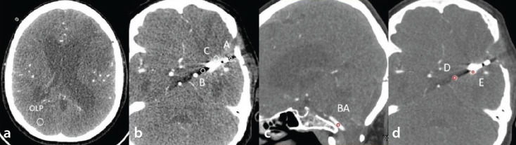 The value of dual-energy computed tomography angiography-based virtual monoenergetic imaging for evaluations after cerebral aneurysm clipping.