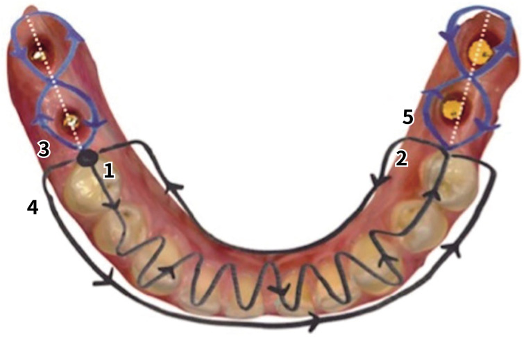 Comparison of fixed dental prostheses digitally fabricated using various scan bodies: a clinical study.