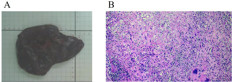 Neoadjuvant Targeted Therapy with Dacomitinib in a Stage IIIA Non-Small-Cell Lung Cancer Patient Harboring <i>EGFR</i> G719X: A Case Report.